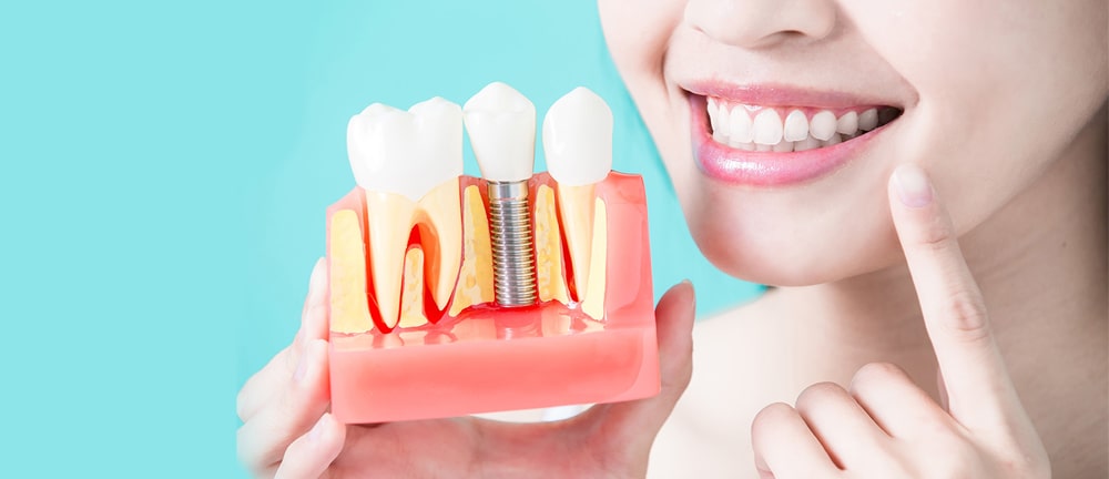 установка импланта зуба