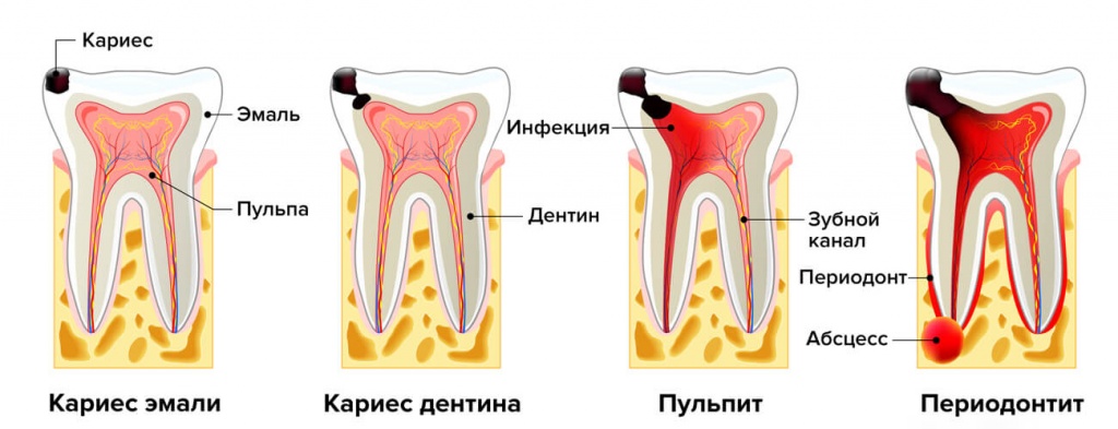 лечение периодонтита переднего зуба