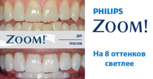 Read more about the article Zoom-отбеливание