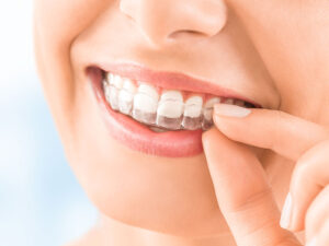 Read more about the article Элайнеры, выравнивание зубов на элайнерах