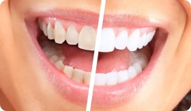 Read more about the article Профессиональная чистка зубов