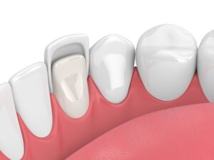 Read more about the article Как крепятся зубные виниры?