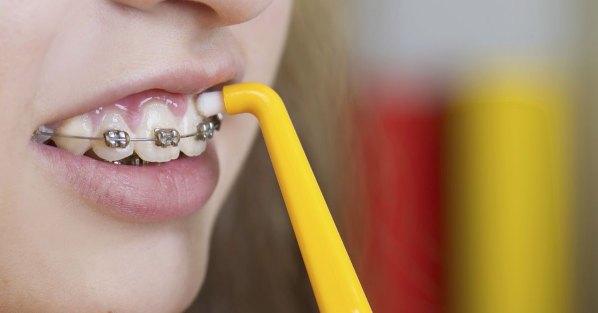 You are currently viewing Особенности выравнивания зубов у детей и взрослых