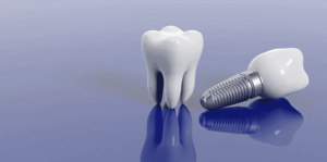 Read more about the article Как выбрать хороший имплант зуба