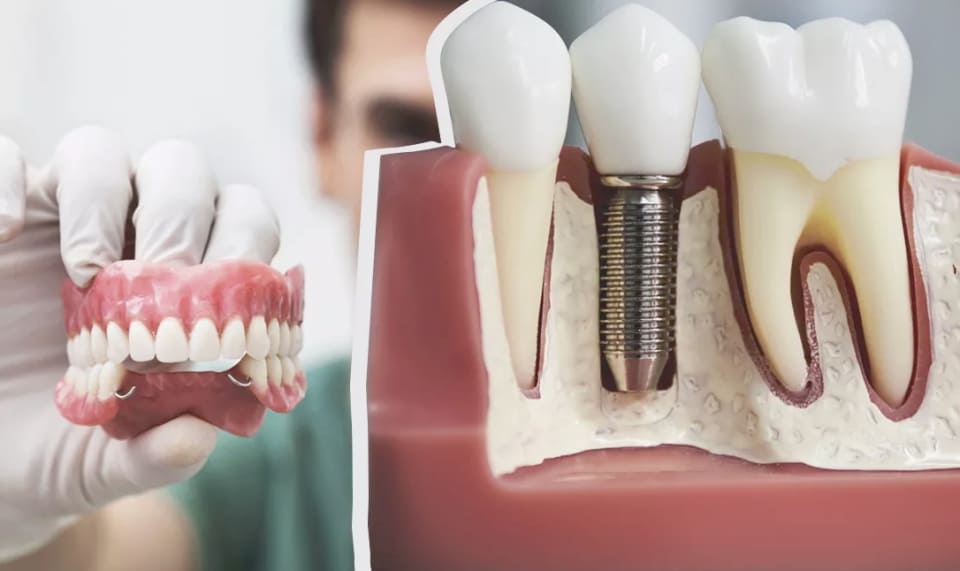 You are currently viewing Зубная имплантация или протезирование: что выбрать?